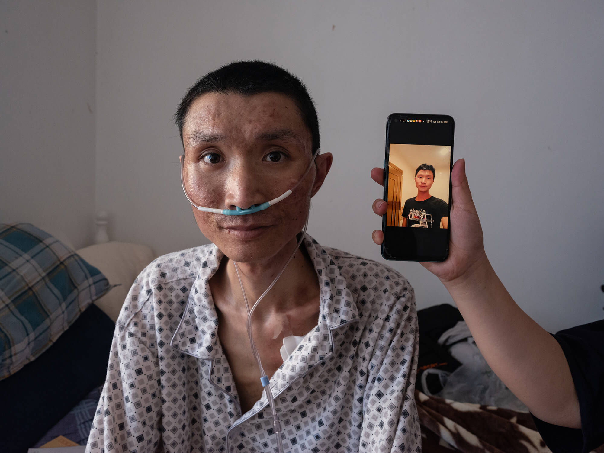 尘肺病患者资料图。长期吸入粉尘可造成不可逆肺部损伤,重症患者需要持续吸氧|来源:财新